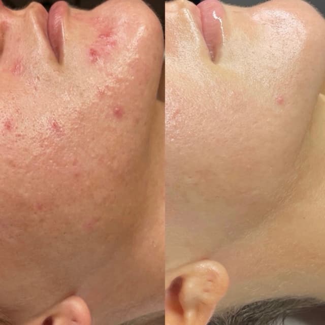Microneedling (Face + Neck + Chest) at Skin Society Hawaii in Honolulu, HI