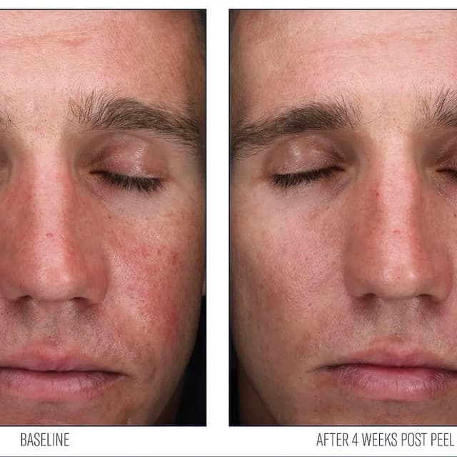 SkinBetter Alpharet Peel - Series at Skin Society Hawaii in Honolulu, HI