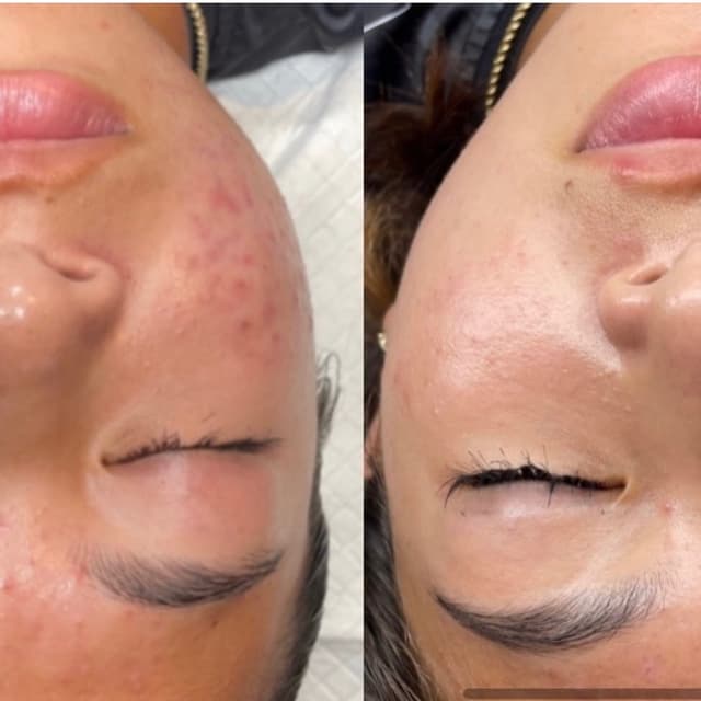 Mini Chemical Peel - Series at Skin Society Hawaii in Honolulu, HI
