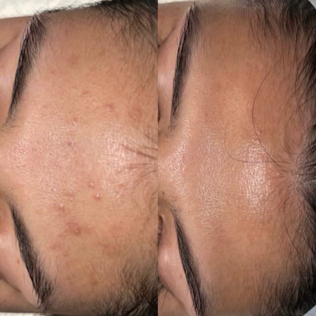 Glymed Advanced Peel - Series at Skin Society Hawaii in Honolulu, HI